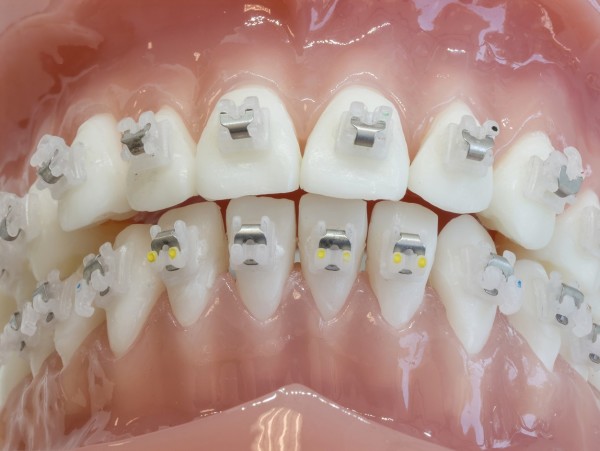 INCIDENTS ET URGENCES ORTHODONTIQUES