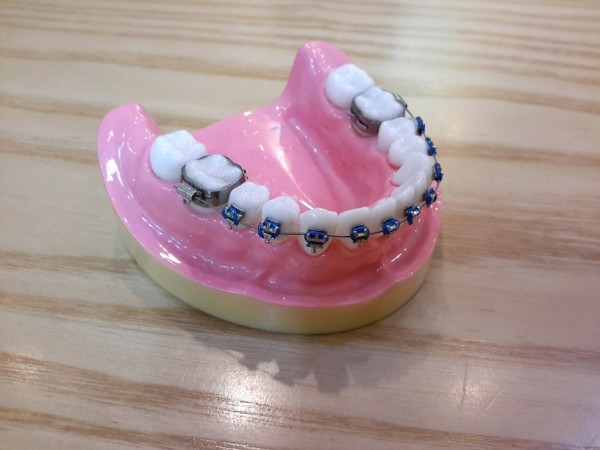 LES MINI-VIS EN ORTHODONTIE