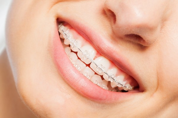 LES APPAREILS ORTHODONTIQUES AUTO-LIGATURANT