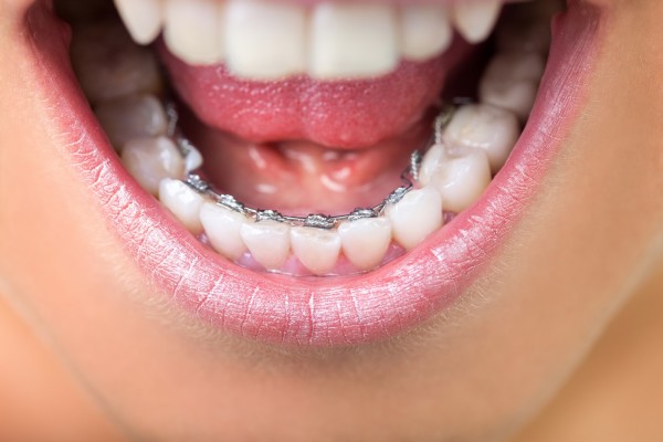 L’ORTHODONTIE LINGUALE