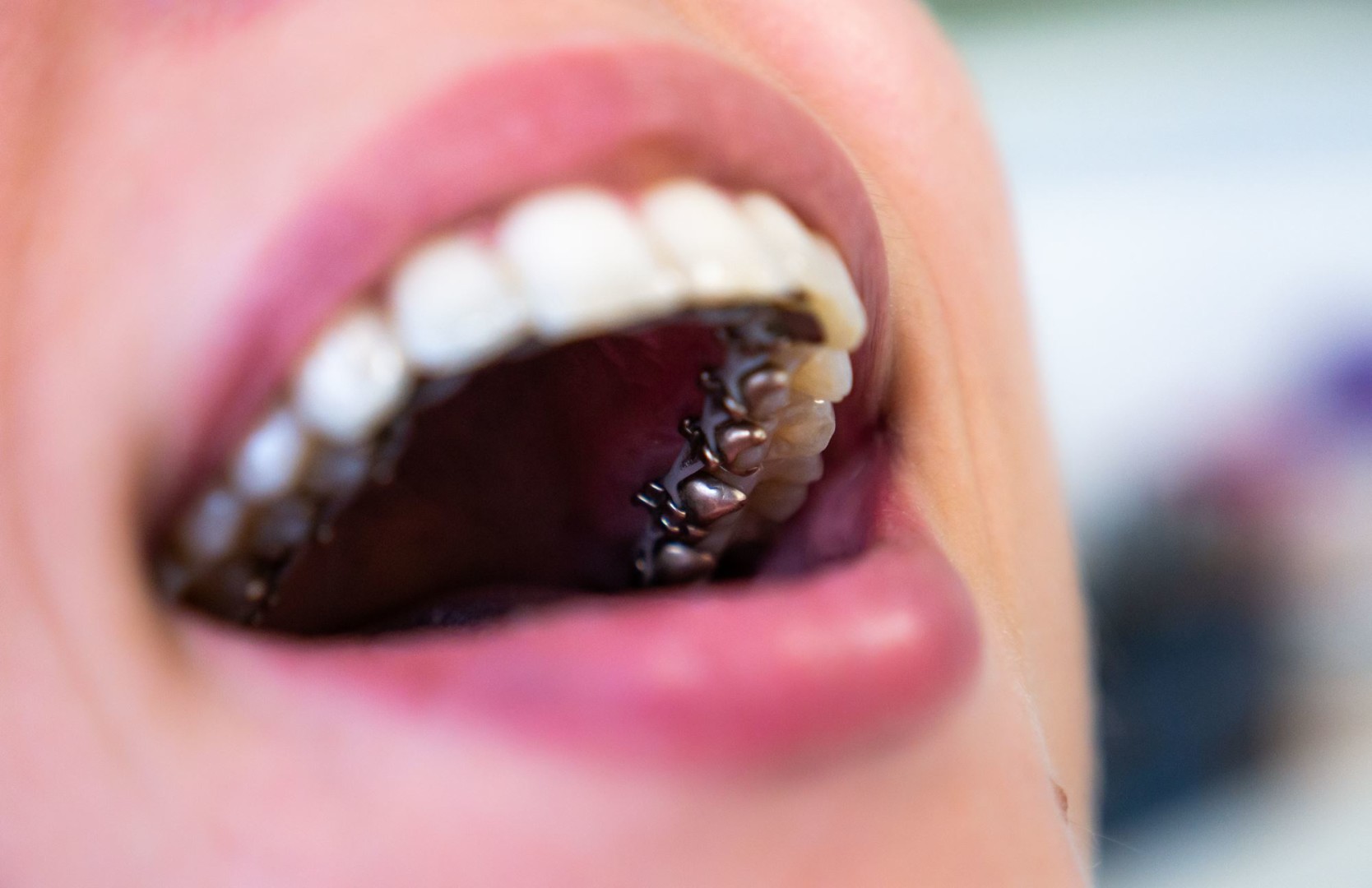 Orthodontie linguale