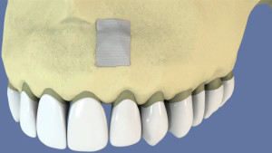 Résection apicale