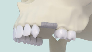 Extraction avec comblement osseux