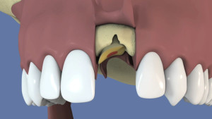 Extraction, implantation et mise en esthétique immédiate