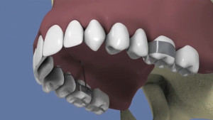 Quad Helix 3D