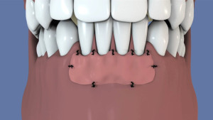 Greffe gingivale libre : la technique de l'autogreffe
