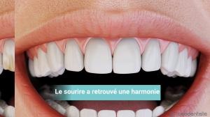 Facettes dentaires