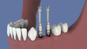 Implant et régénération osseuse